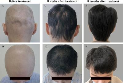 Case Report: Reversal of Long-Standing Refractory Diffuse Non-Scarring Alopecia Due to Systemic Lupus Erythematosus Following Treatment With Tofacitinib
